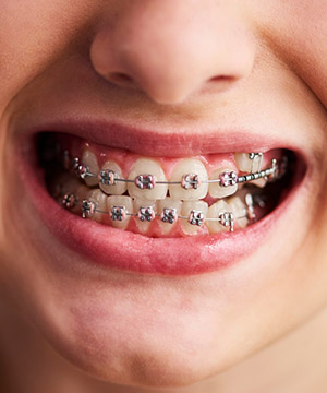 Metalne fiksne proteze